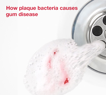 Corsodyl - How plaque bacteria causes gum disease