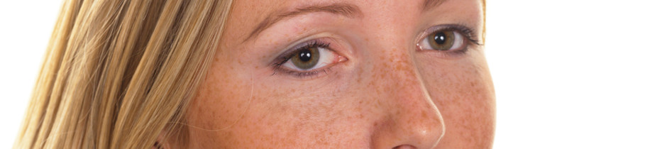 Hyperpigmentation