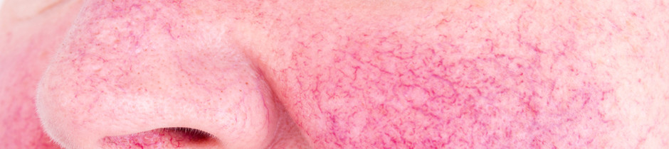 Rosacea